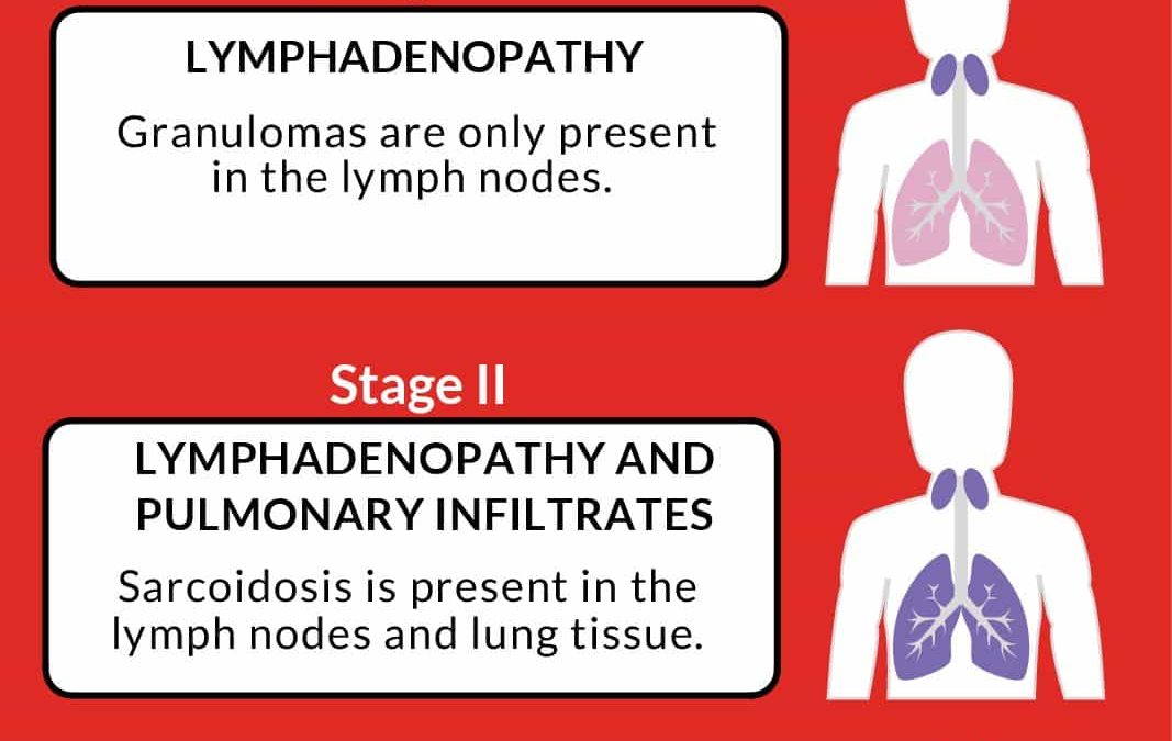Understanding the Stages of Pulmonary Sarcoidosis