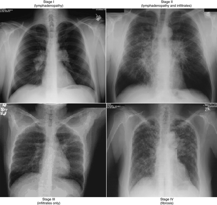 The Stages Of Pulmonary Sarcoidosis What Do They Really Mean 