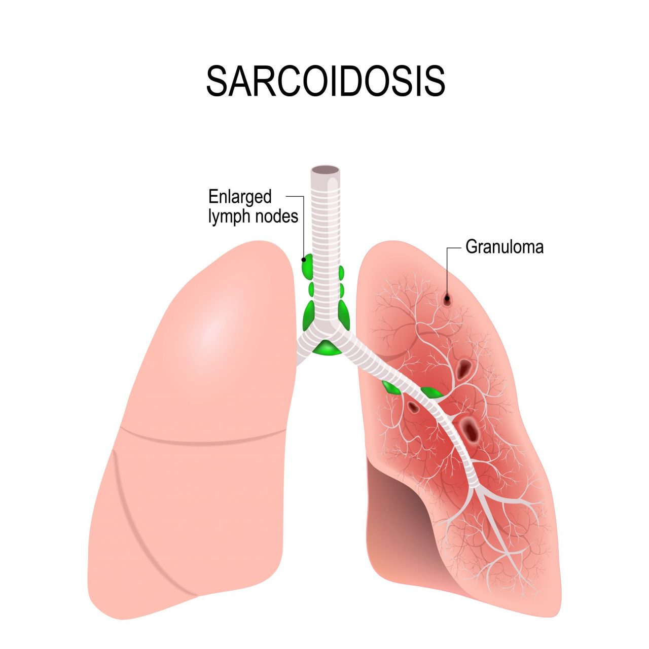 Pulmonary Sarcoidosis — Foundation For Sarcoidosis Research